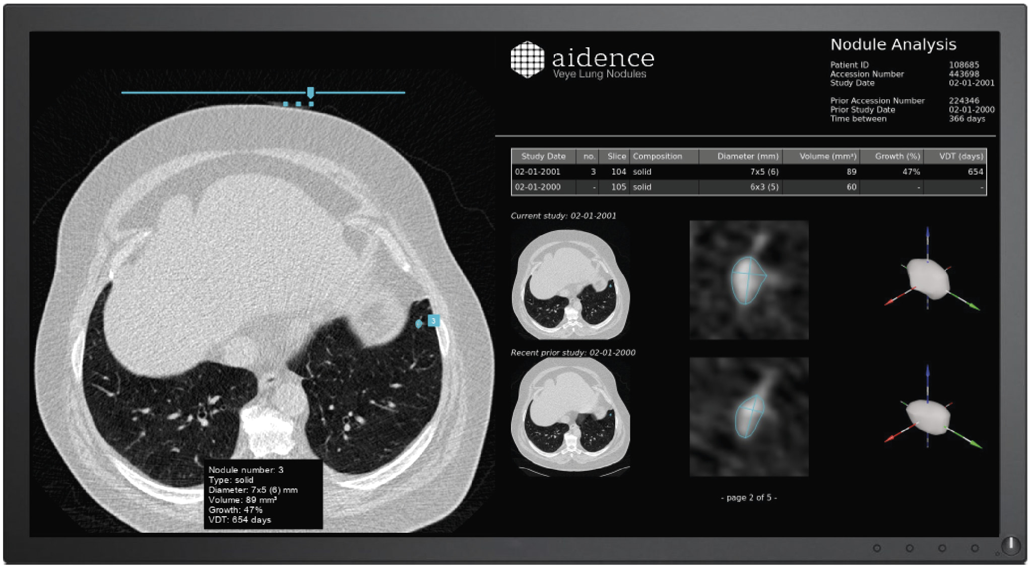 Aidence’s system helps detect, measure, classify and track the growth of lung nodules - Image of Veye Lung Nodules.