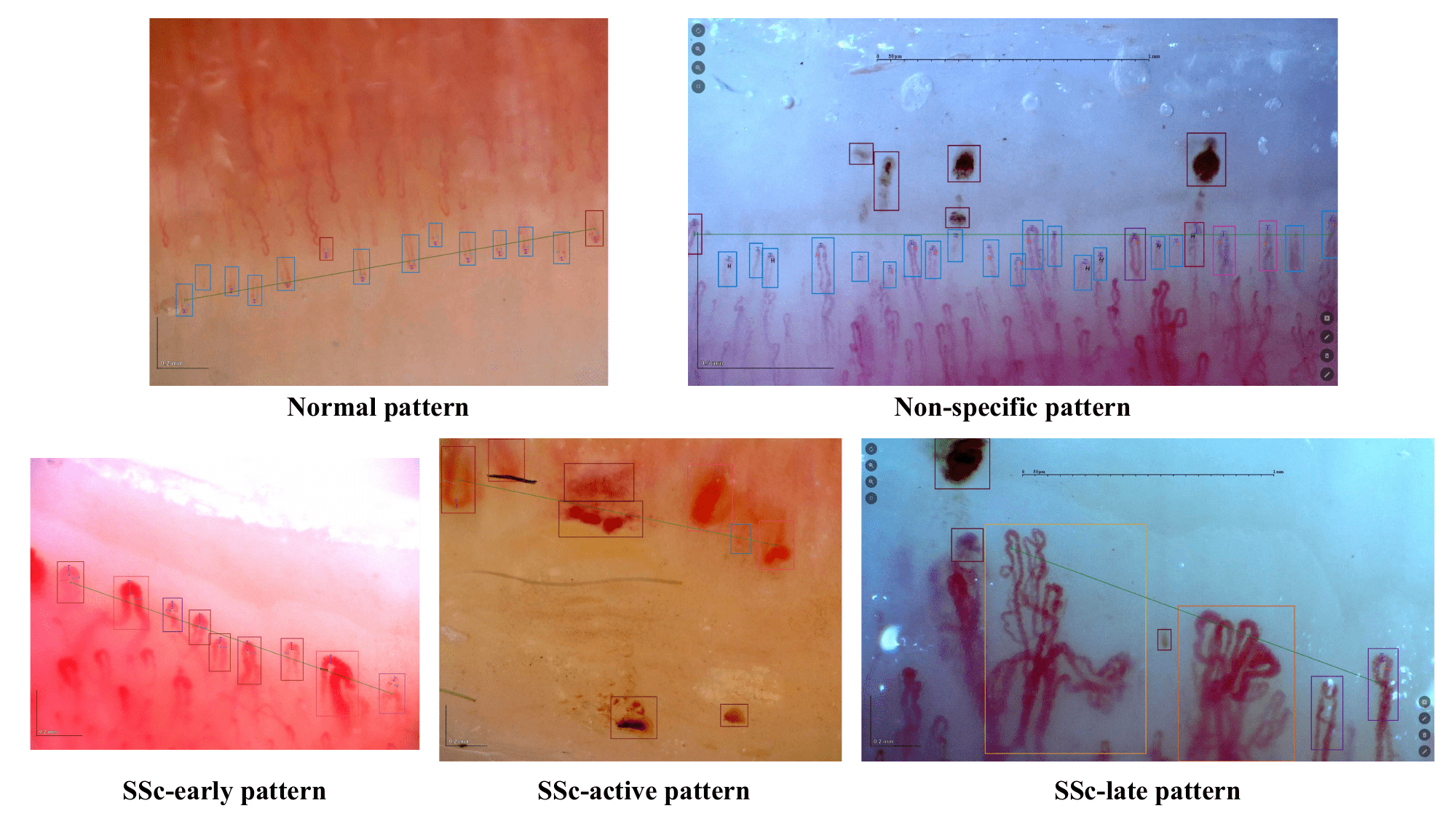 Examples of capillaroscopic patterns.