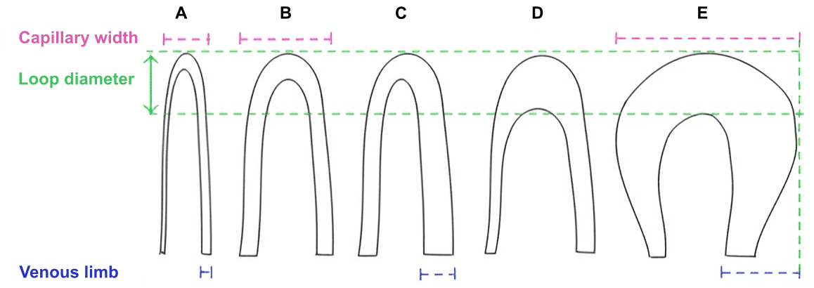 Capillaries morphology: (A) normal capillary loop, (B) enlarged afferent capillary loop, (C) enlarged efferent capillary loop, (D) enlarged apical capillary loop, and (E) horseshoe shape giant loop. Source: Nailfold Capillaroscopy in Rheumatic Diseases: Which Parameters Should Be Evaluated?
