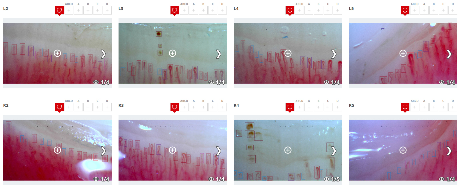 Example of a capillaroscopy where capillaries and hemorrhages can be seen framed and marked with different colors according to their type and size.