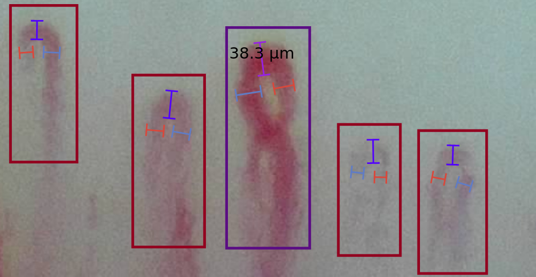 Example of measurements in several capillaries. A tortuous capillary has an apical diameter of 38.3 microns.