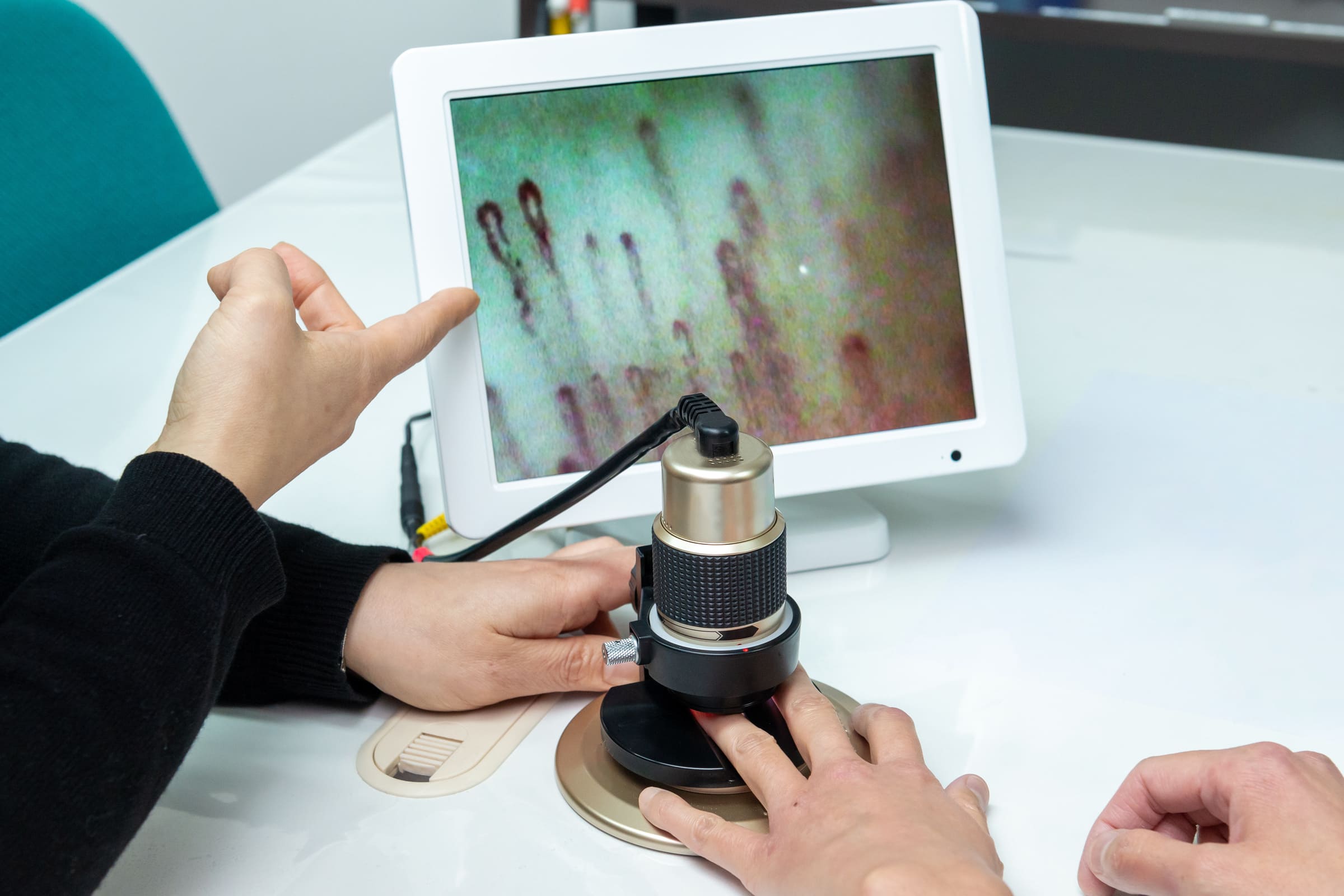 Capillaroscopy procedure - The doctor examines the patient nailbed with a microscope