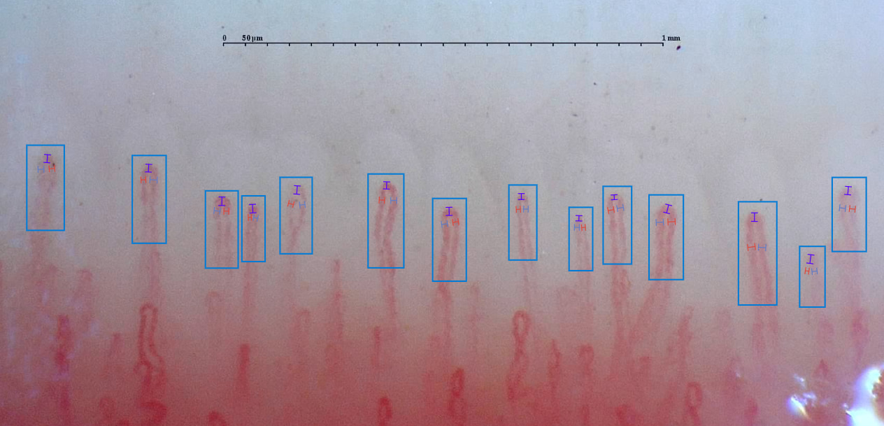 Example of capillaroscopy in which normal capillaries can be observed