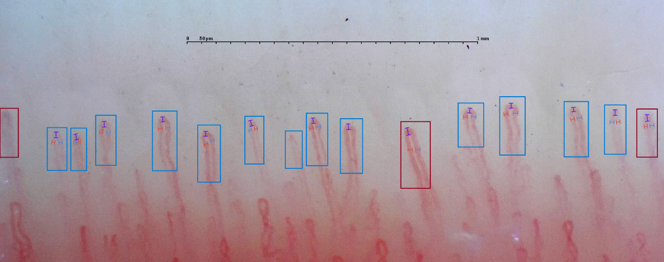 Example of capillaroscopy in which normal capillaries can be observed