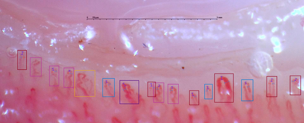 Example of capillaroscopy where some alterations can be observed