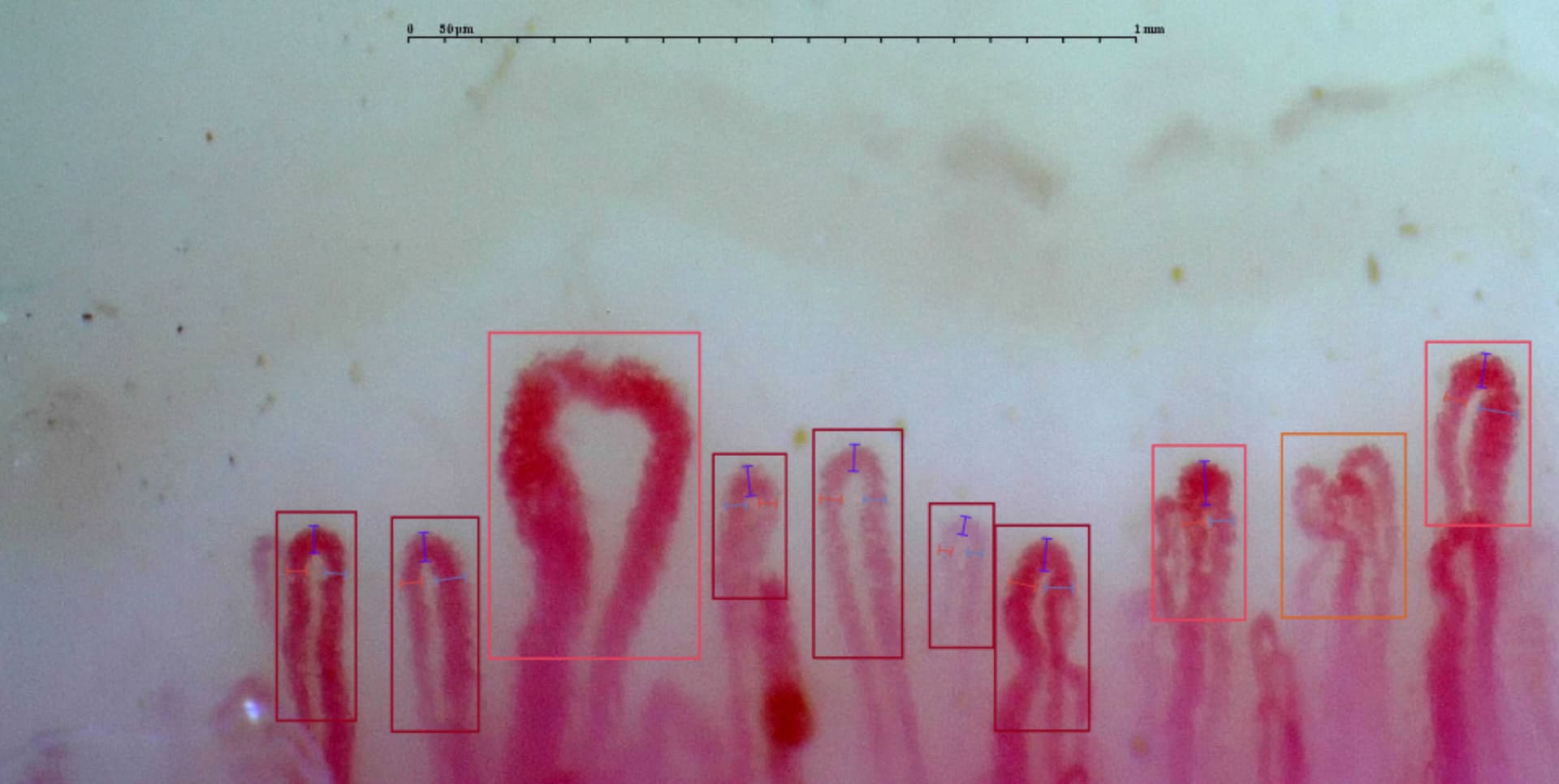 Example of capillaroscopy where enlarged and giant capillaries can be observed