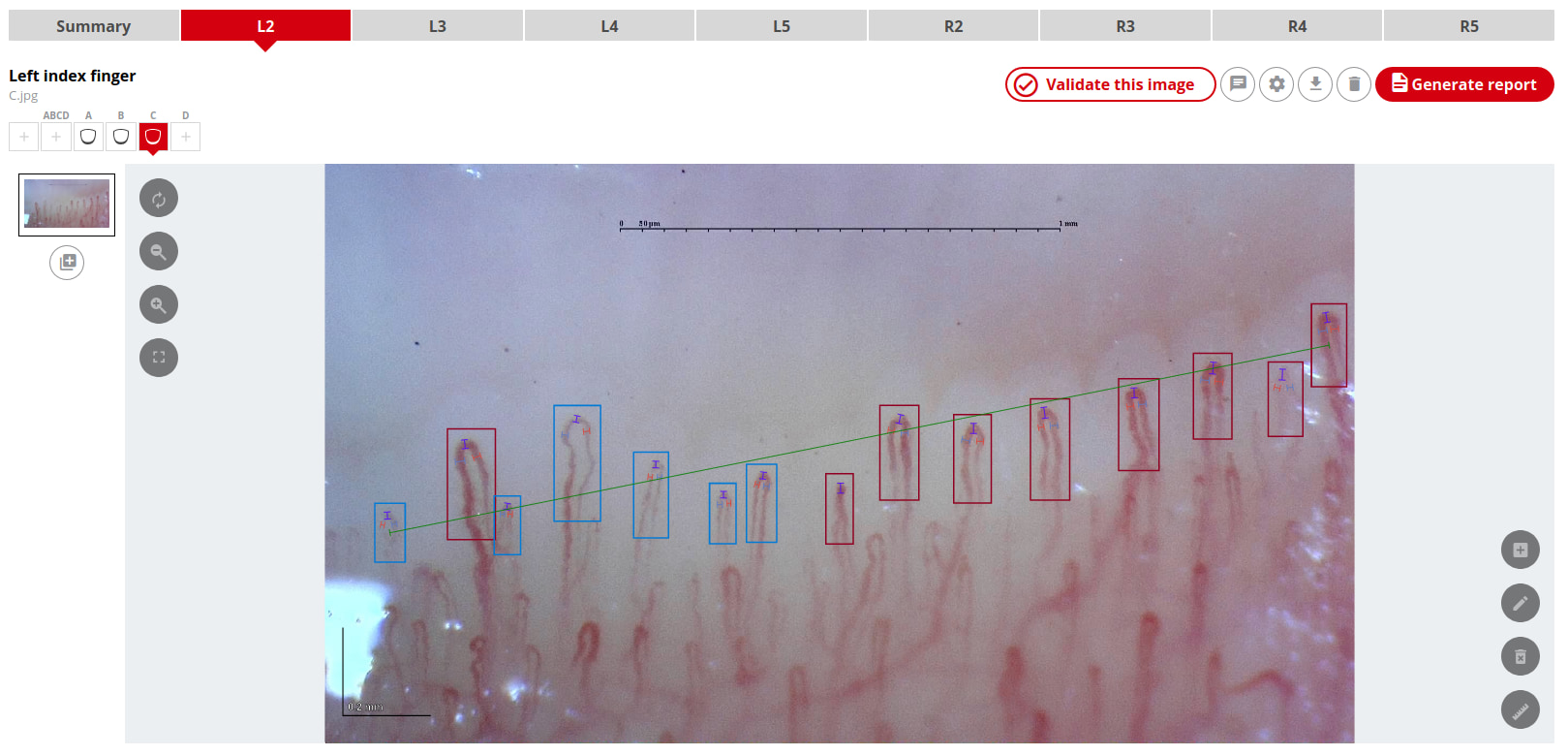 Capillary.io’s system automates capillary detection, measurement, and classification in all of your nailfold capillaroscopy images.