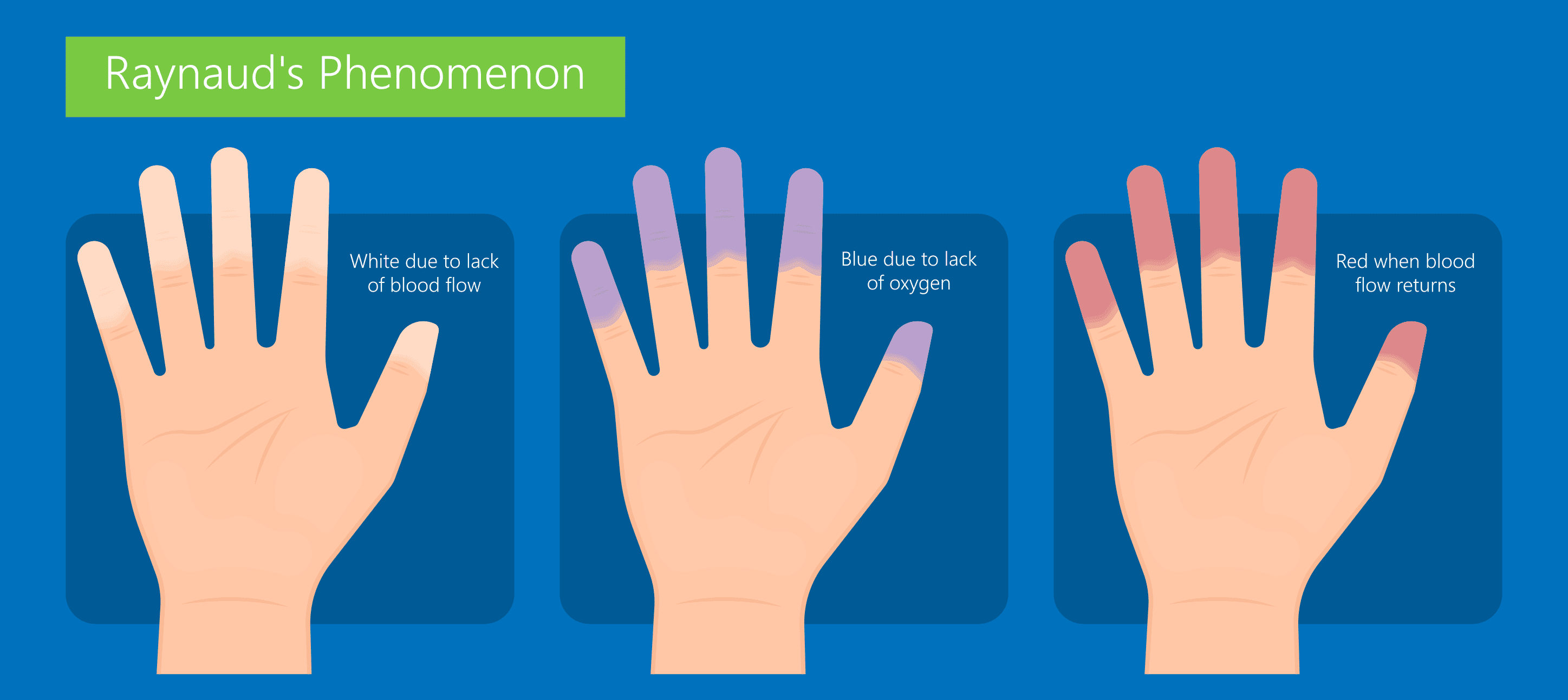 Raynaud&rsquo;s phenomenon - finger color changes