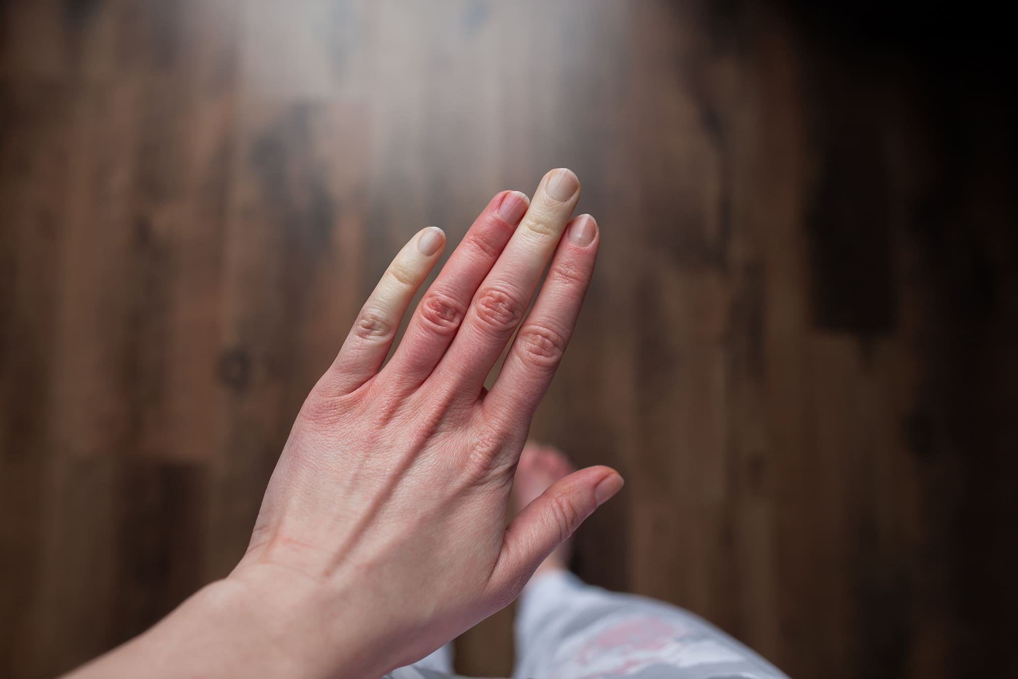 In this article you can learn about nailfold capillaroscopy importance in Raynaud's Phenomenon.