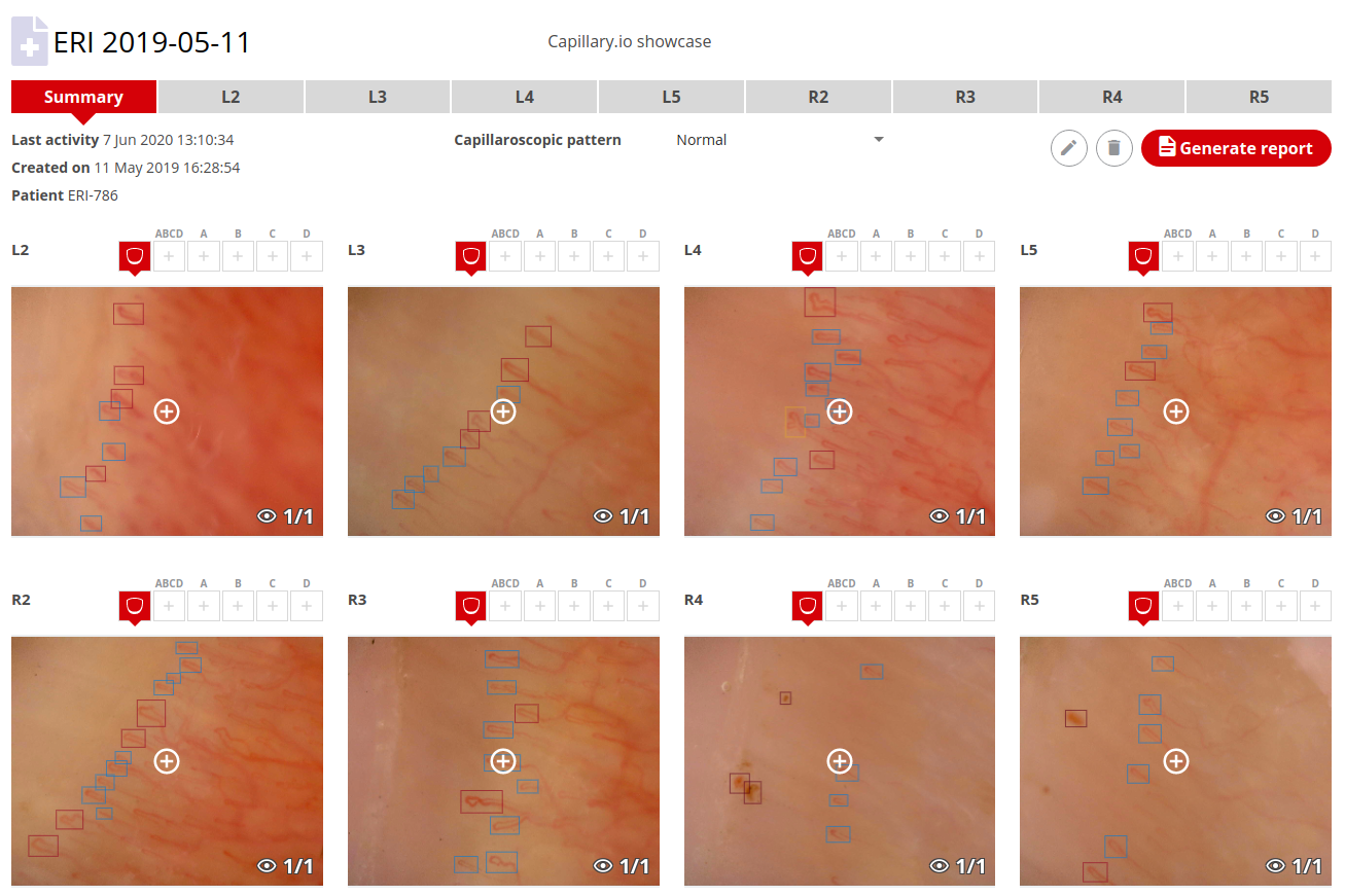 Example Capillaroscopy