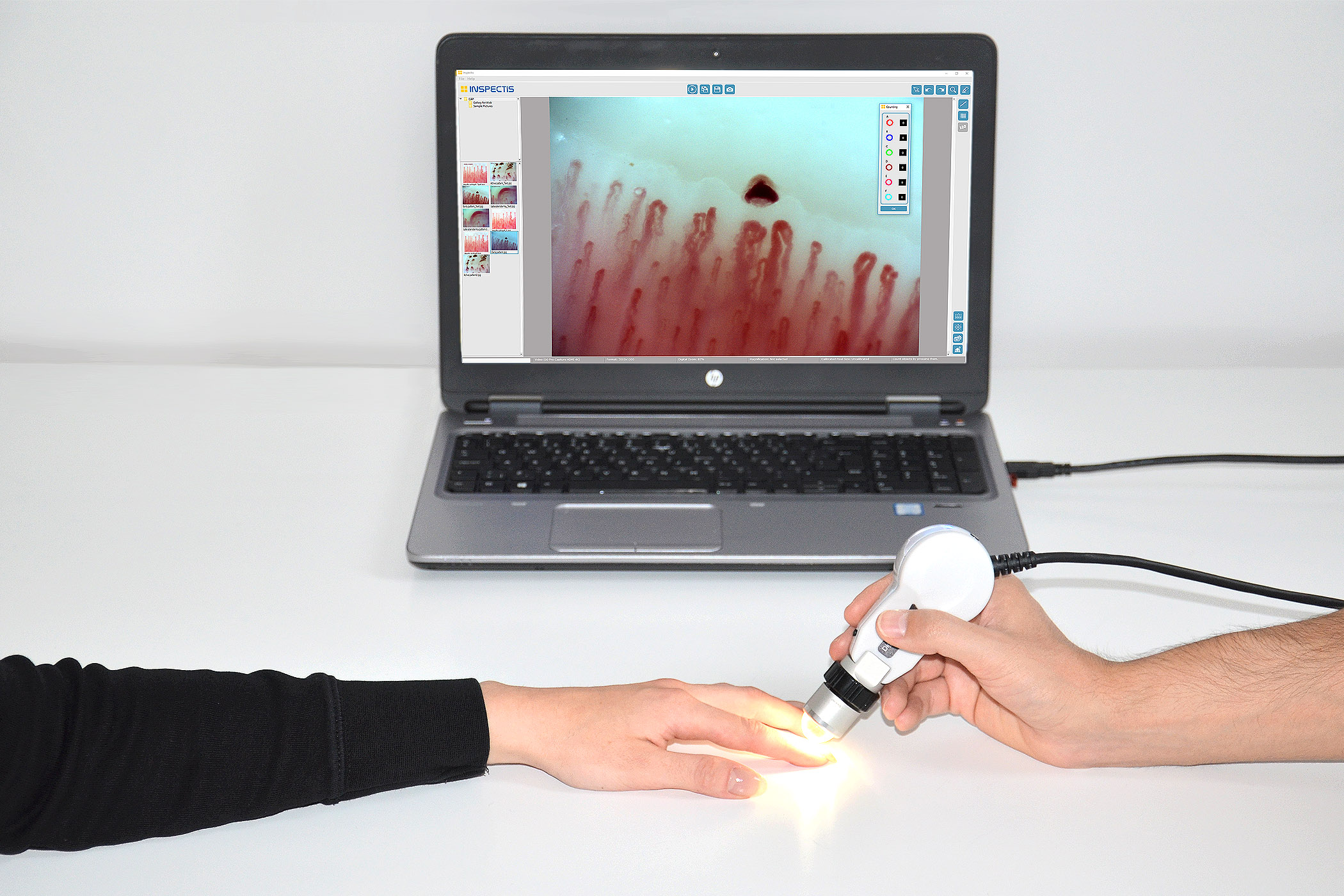 Inspectis capillaroscope connected to a laptop displaying nailfold capillary images during an examination