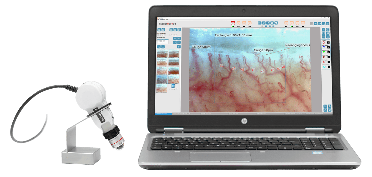 Inspectis digital video capillaroscope connected to a laptop showing a nailfold image