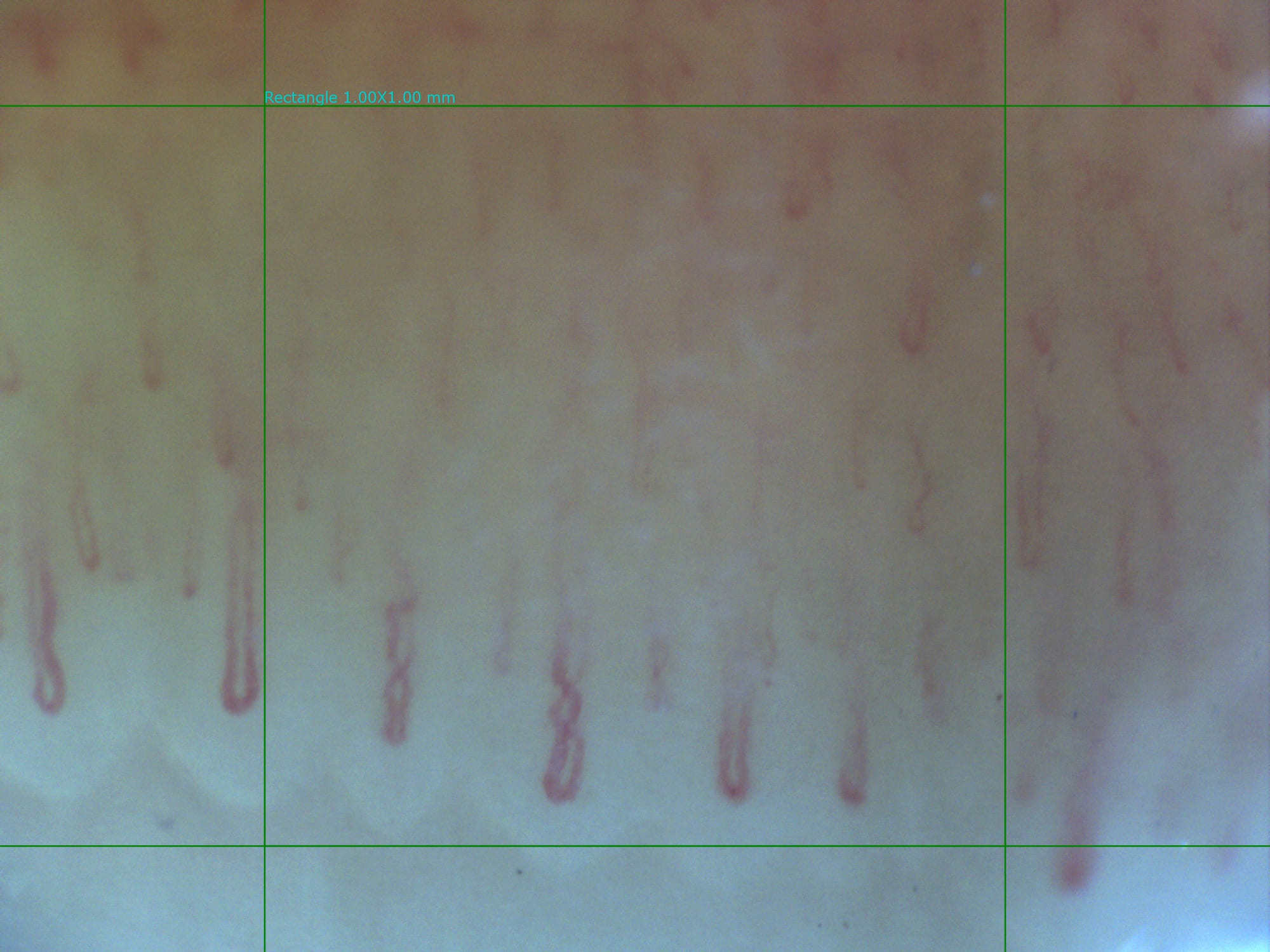 Capillaroscopy example with Optilia Digital Capillaroscope